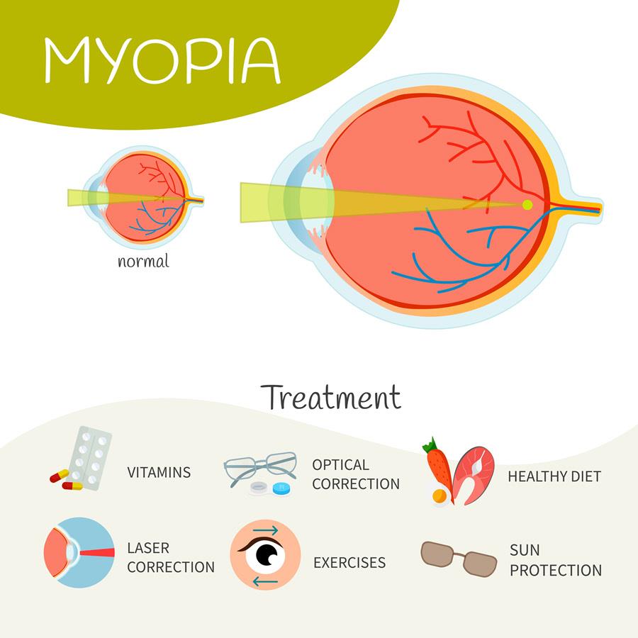 Myopia Nearsightedness Eye Patient