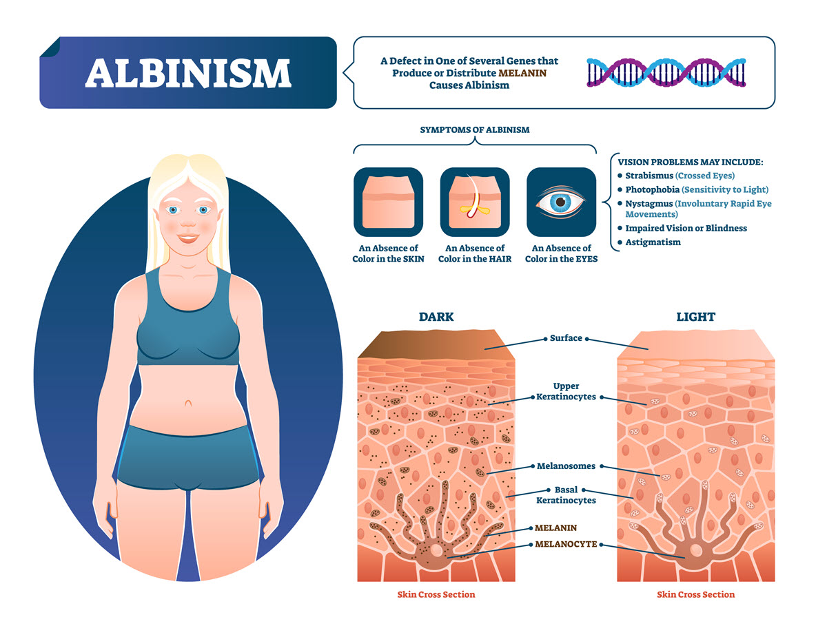 Albinism Eye Patient