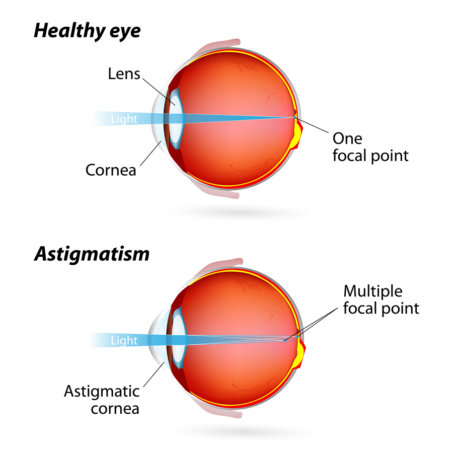 Stigmatism Vs Astigmatism Astigmatism Vs Myopia What s The 