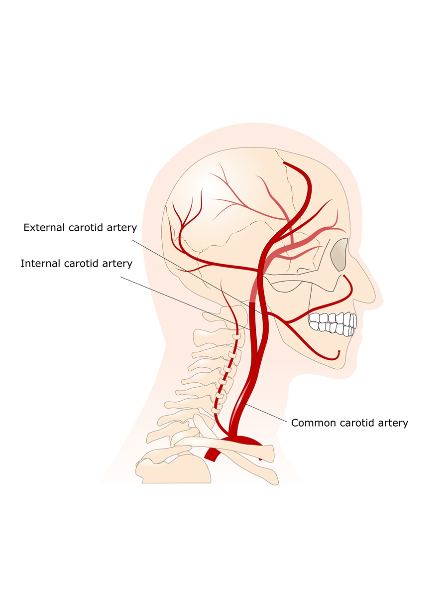 pressure on carotid artery