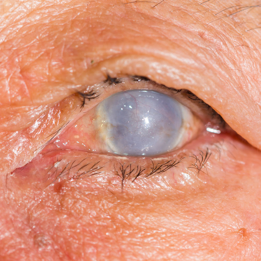 Corneal Opacity Wikipedia 56 OFF Brunofuga adv br