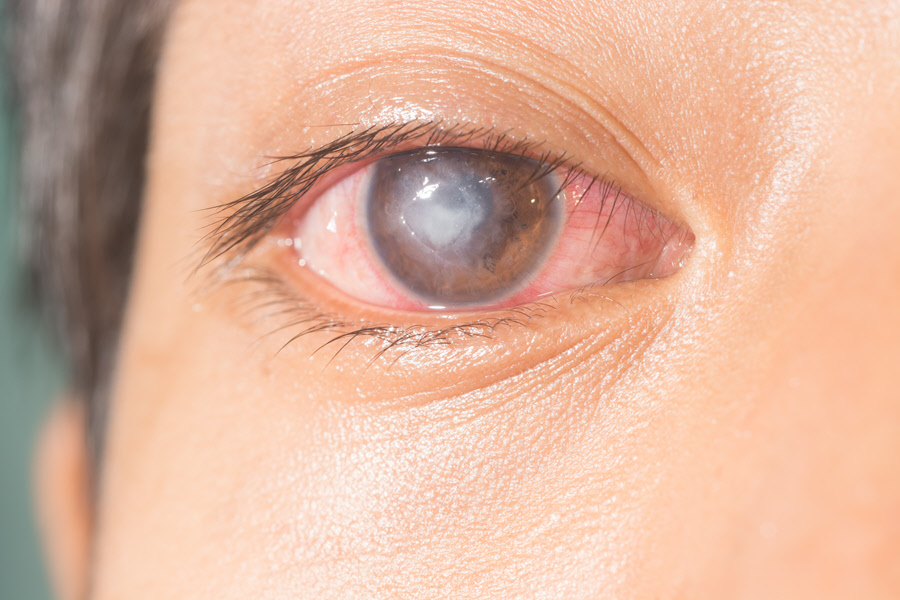 Corneal Ulcer Eye Patient