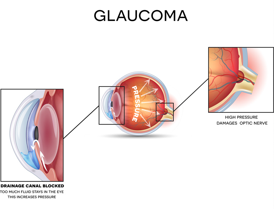congenital glaucoma diagram
