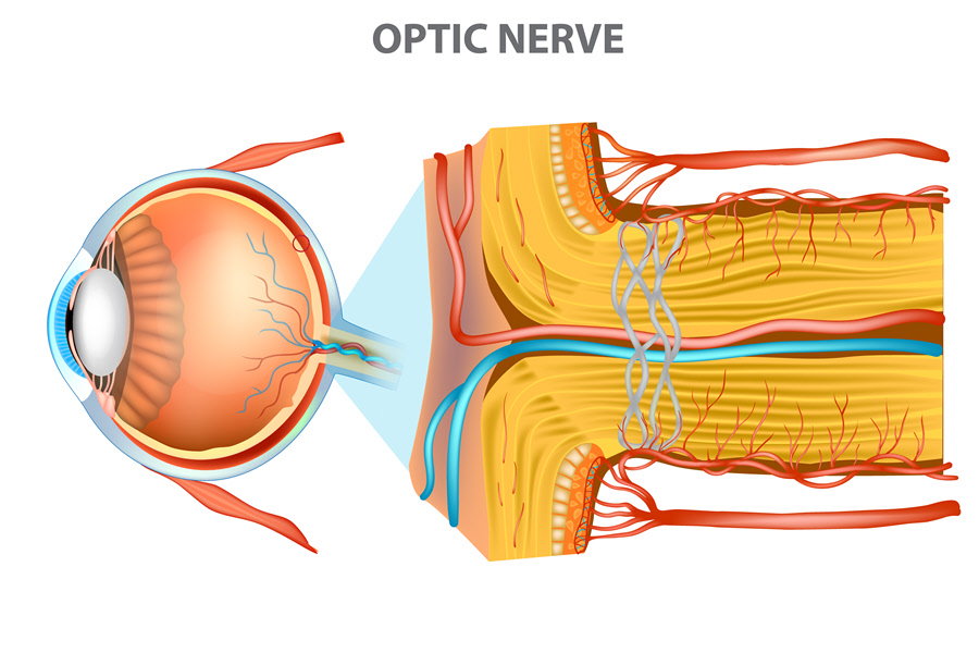 Optic Nerve Eye Patient