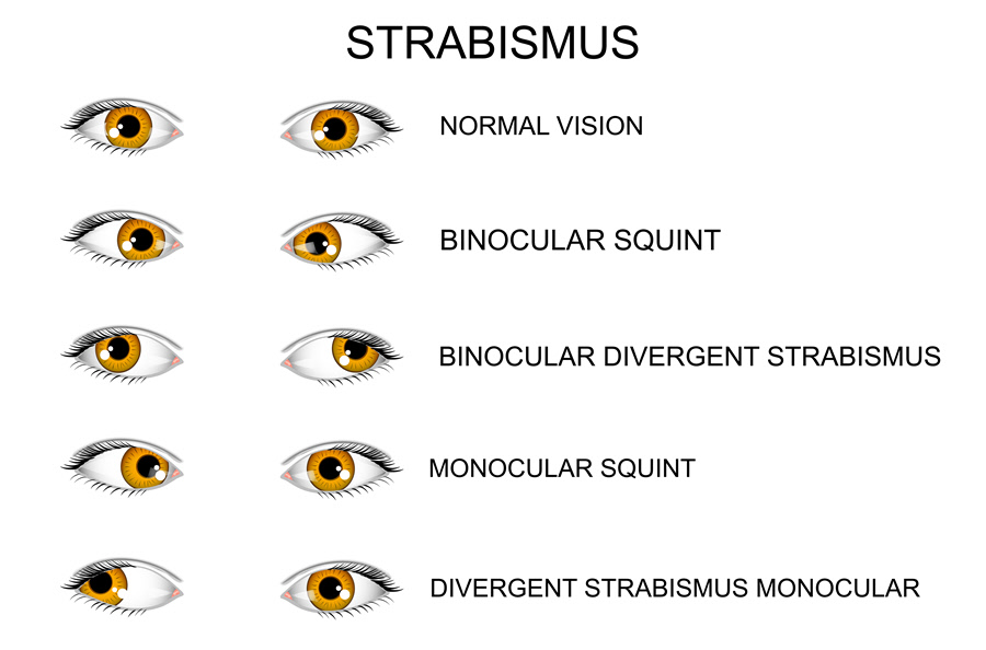 Strabismus (Crossed Eyes) - All About Vision